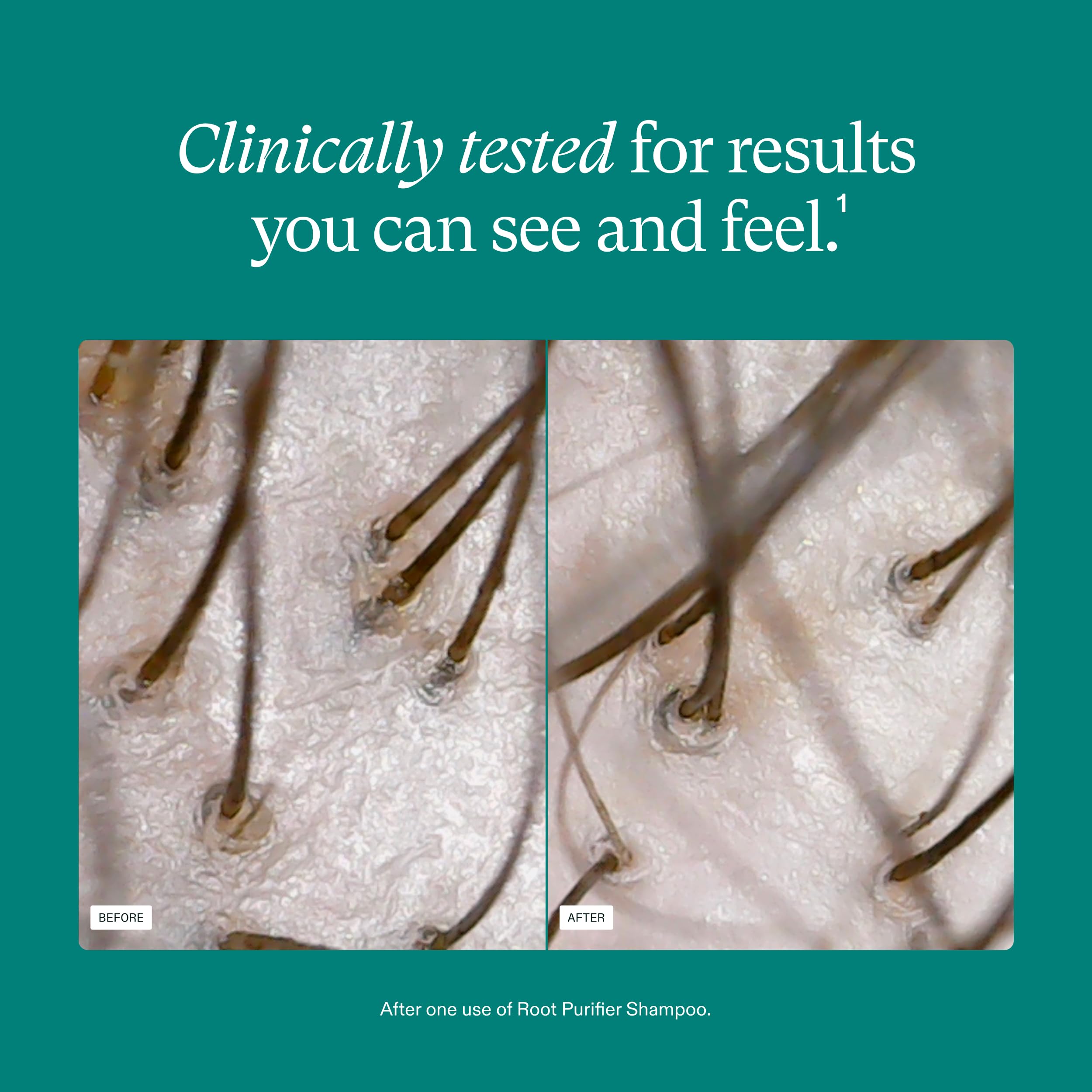 "Resultados de Nutrafol shampoo para cabello fino y debilitado"